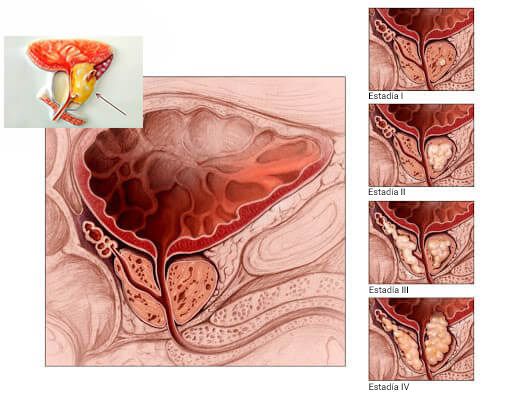Le garantizo que todo hombre con prostatitis tendrá acceso al mejor
tratamiento para esta enfermedad
